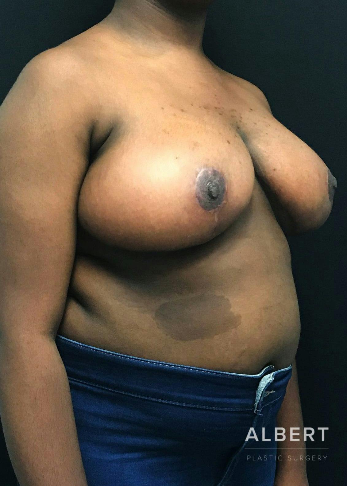 Breast Lift / Reduction Before & After Gallery - Patient 151362539 - Image 8