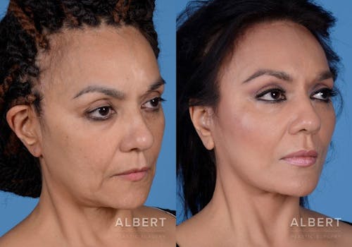 Facelift Procedure