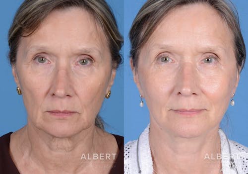 Facelift Procedure