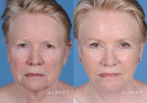 Facelift Procedure