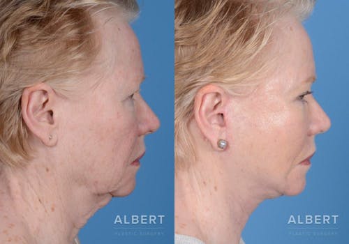 Neck Lift Procedure