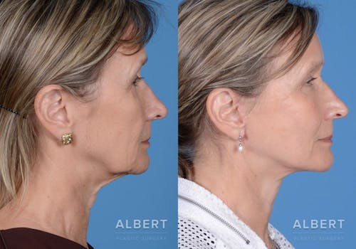 Neck Lift Procedure
