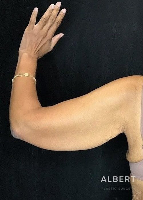 arm lift procedure