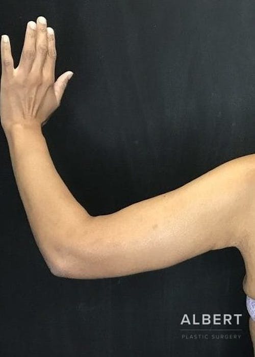 arm lift procedure
