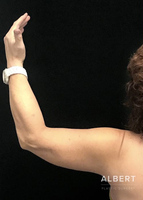 arm lift procedure