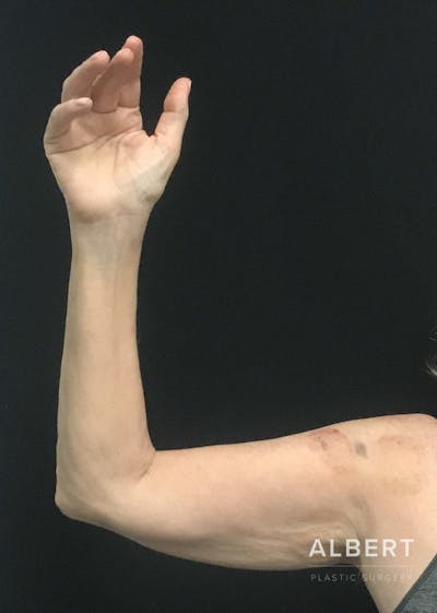Brachioplasty Before & After Gallery - Patient 151351695 - Image 1