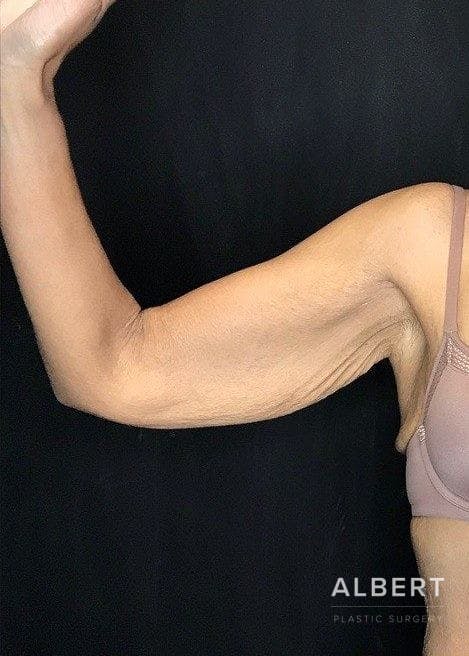 Brachioplasty Before & After Gallery - Patient 151351692 - Image 3