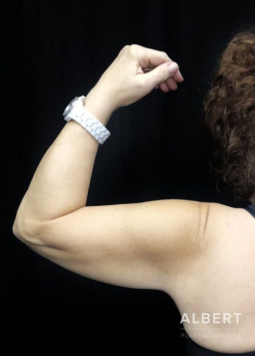 arm lift procedure