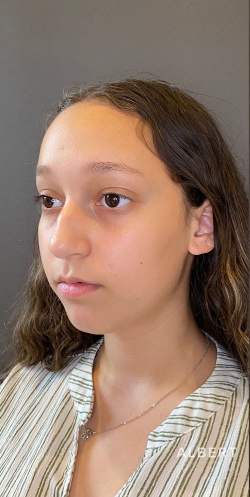 Rhinoplasty Procedure