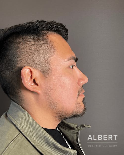 Rhinoplasty Procedure