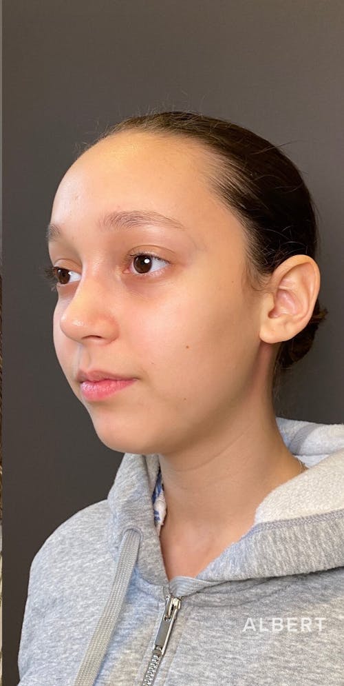 Rhinoplasty Procedure