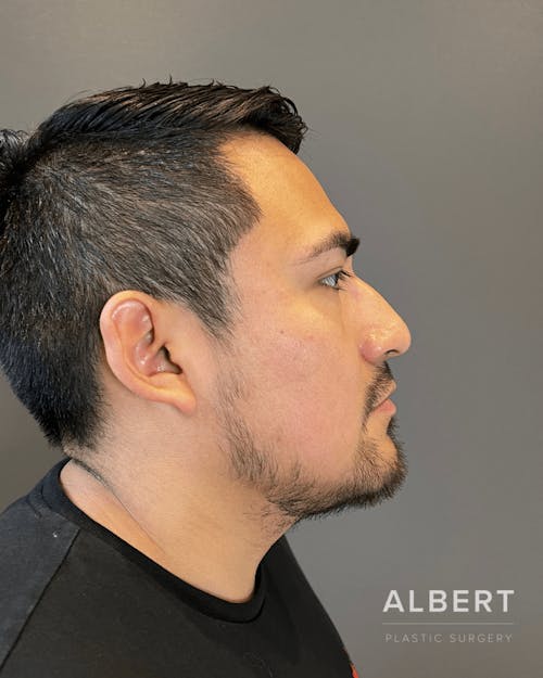 Rhinoplasty Procedure