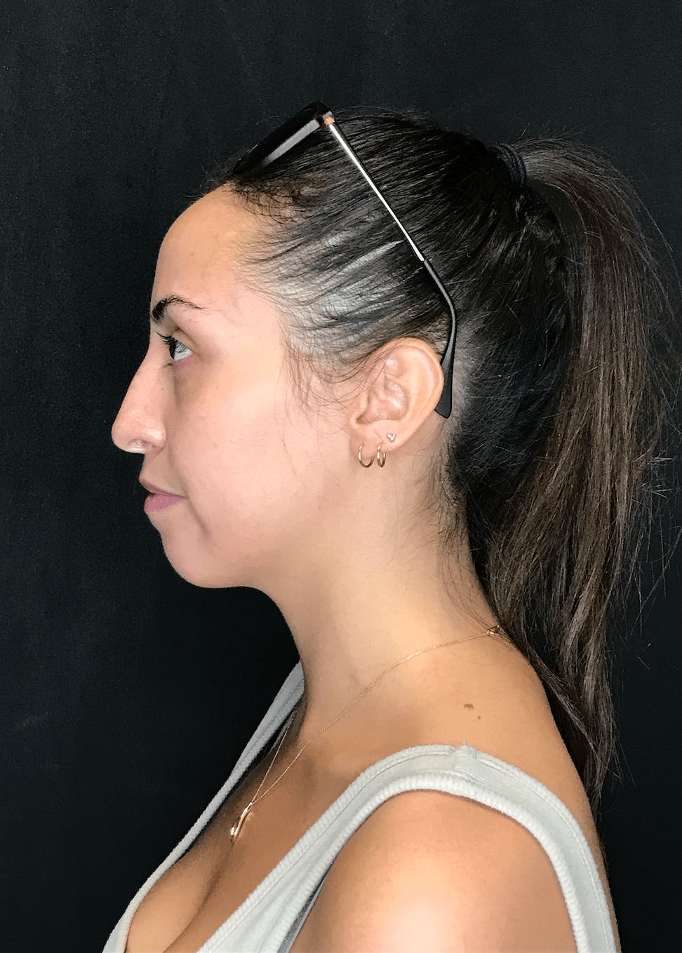 Rhinoplasty Before & After Gallery - Patient 151510785 - Image 7