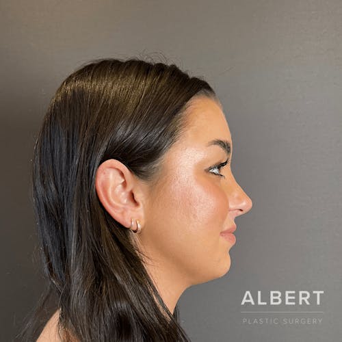 Rhinoplasty Procedure