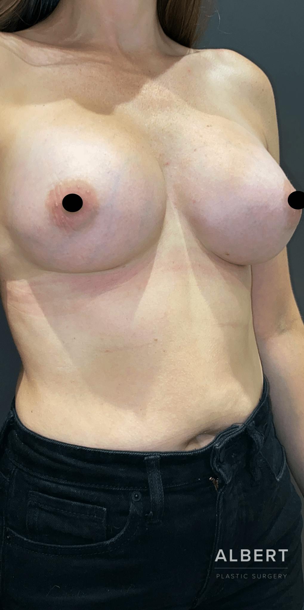 Breast Augmentation Before & After Gallery - Patient 151362510 - Image 6