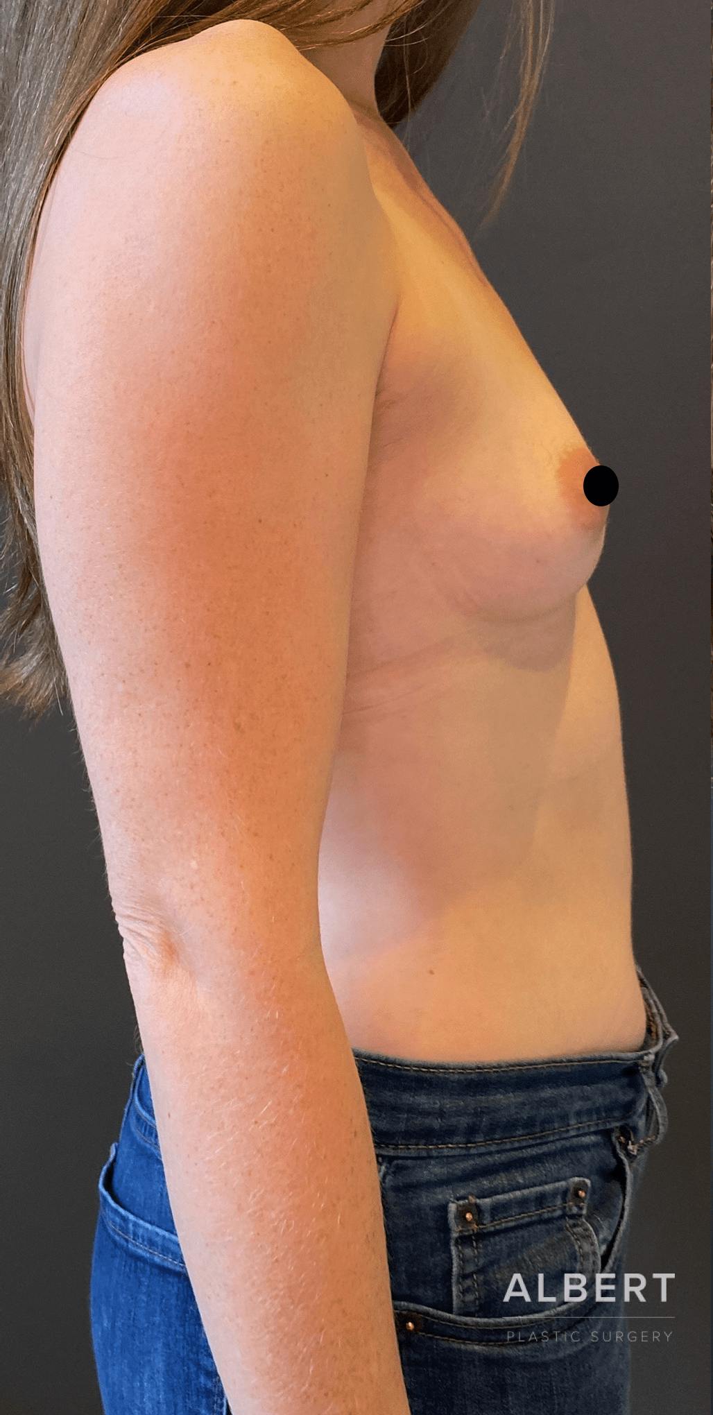Breast Augmentation Before & After Gallery - Patient 151362510 - Image 7