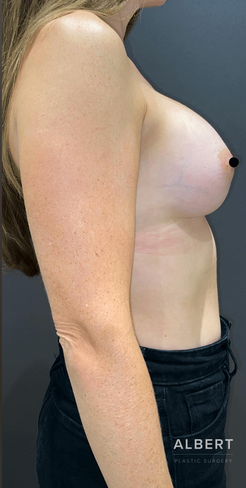 Breast Augmentation Before & After Gallery - Patient 151362510 - Image 8