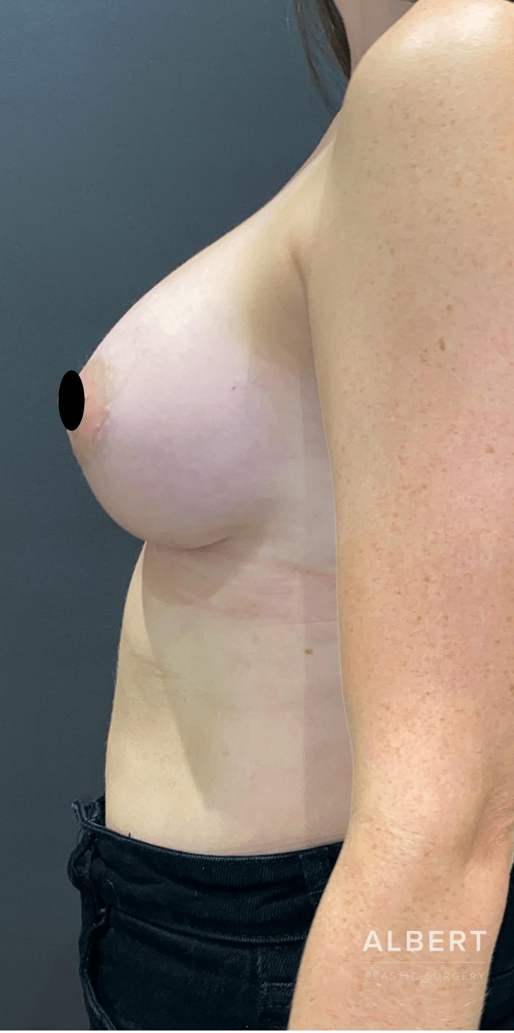 Breast Augmentation Before & After Gallery - Patient 151362510 - Image 10