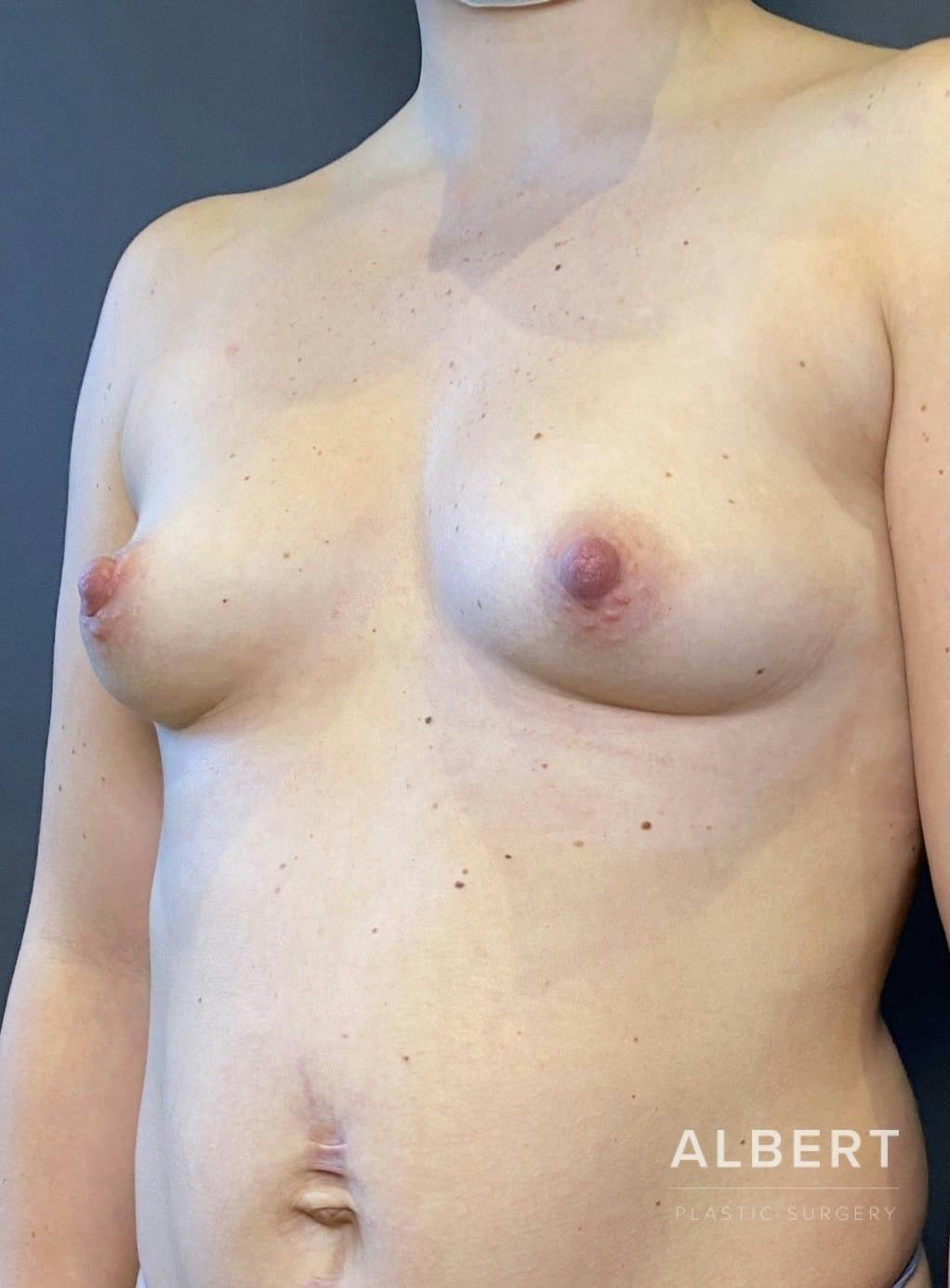 Breast Augmentation Before & After Gallery - Patient 151362509 - Image 7