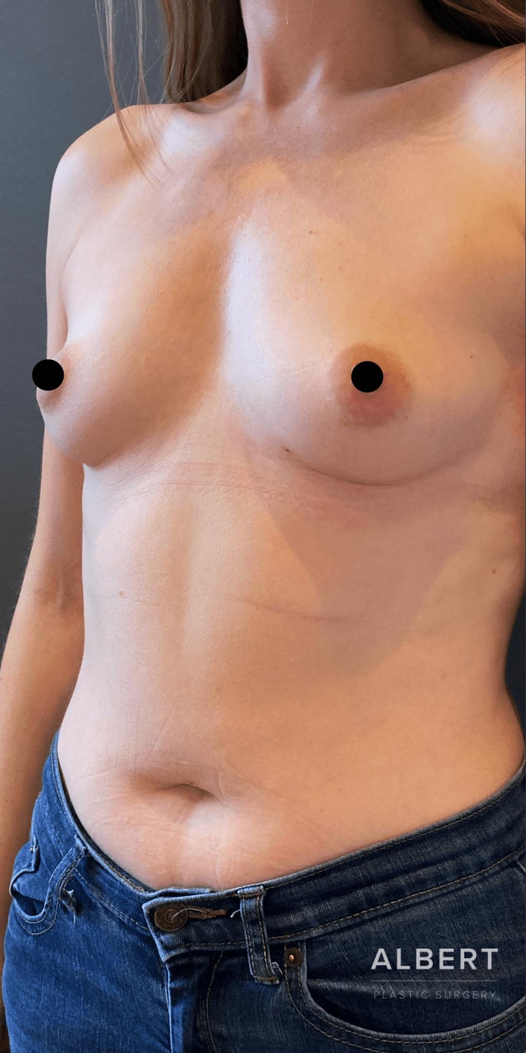 Breast Augmentation Before & After Gallery - Patient 151362510 - Image 3