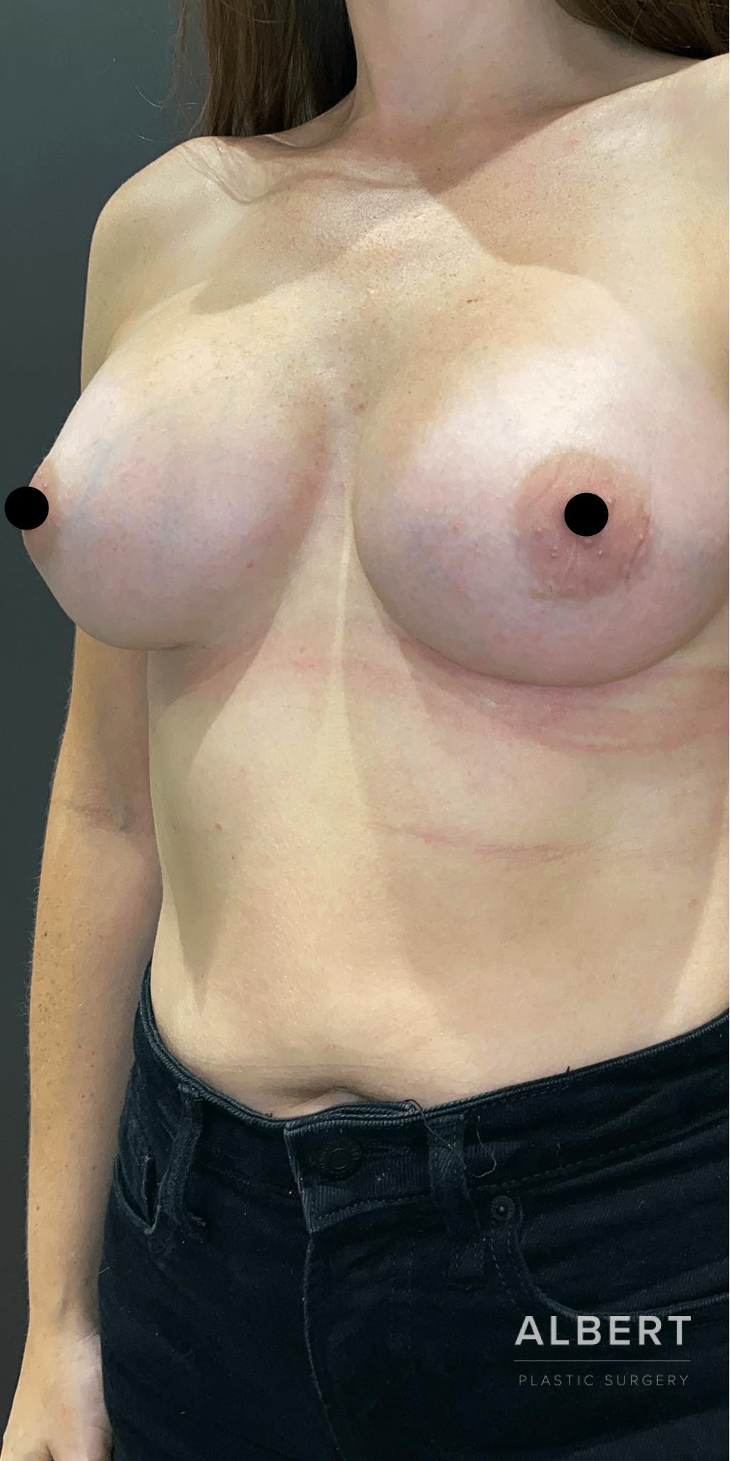 Breast Augmentation Before & After Gallery - Patient 151362510 - Image 4