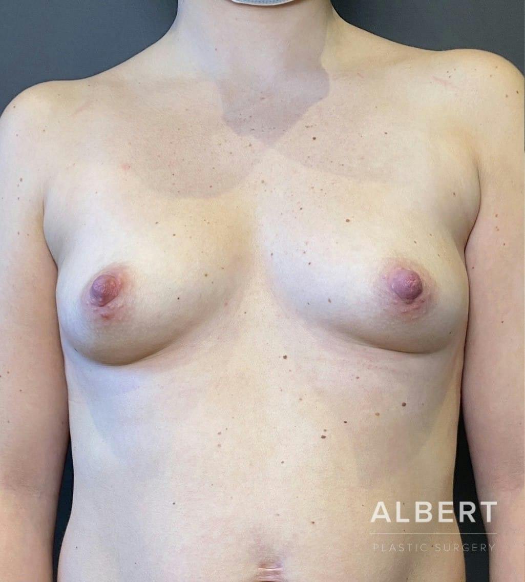 Breast Augmentation Before & After Gallery - Patient 151362509 - Image 1