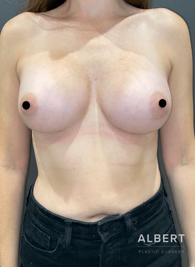 Breast Augmentation Before & After Gallery - Patient 151362510 - Image 2