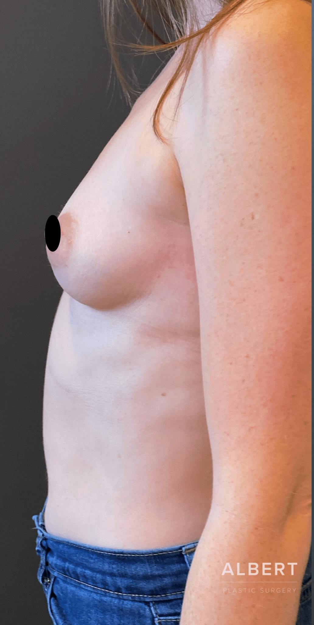 Breast Augmentation Before & After Gallery - Patient 151362510 - Image 9