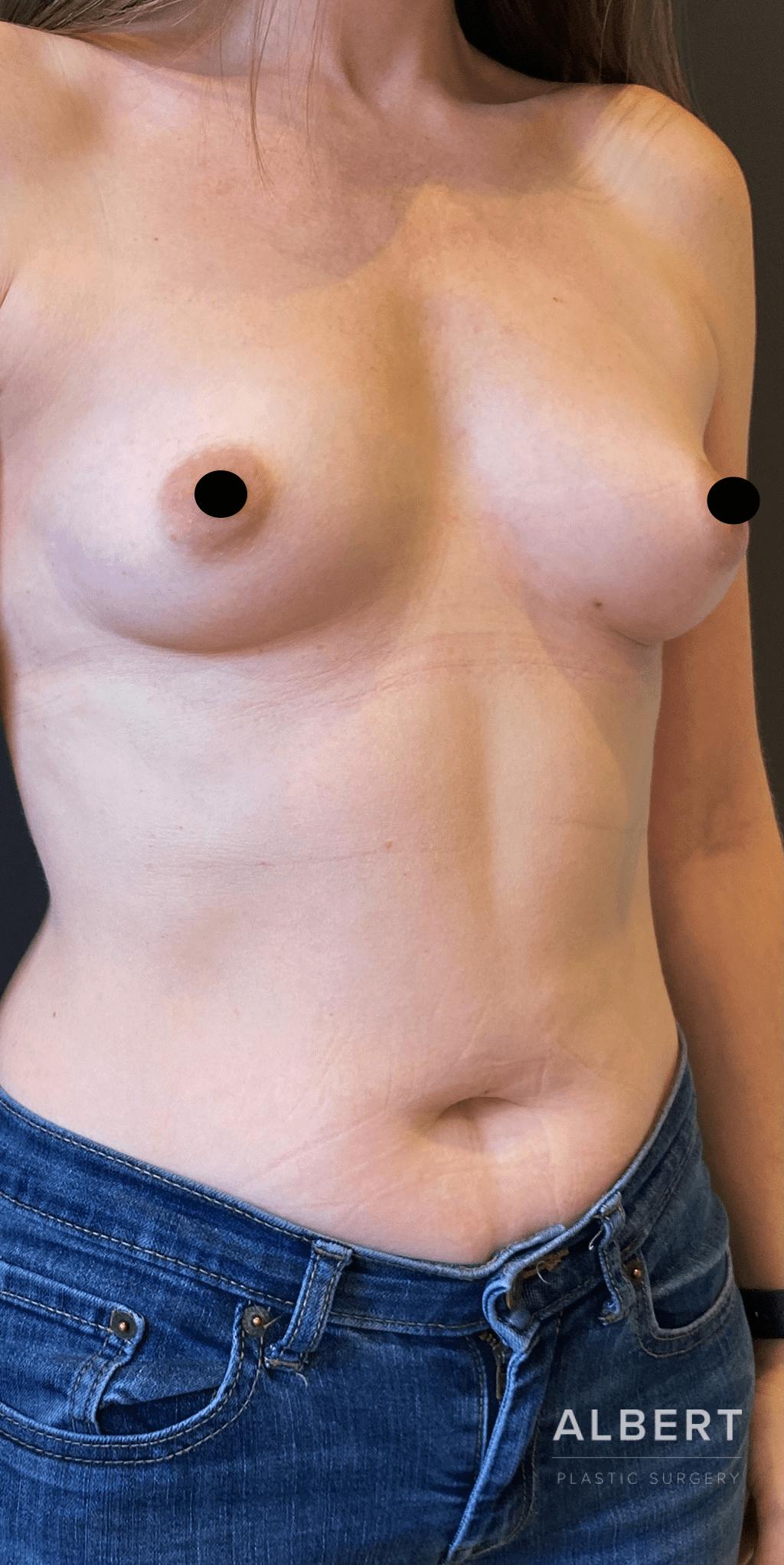 Breast Augmentation Before & After Gallery - Patient 151362510 - Image 5