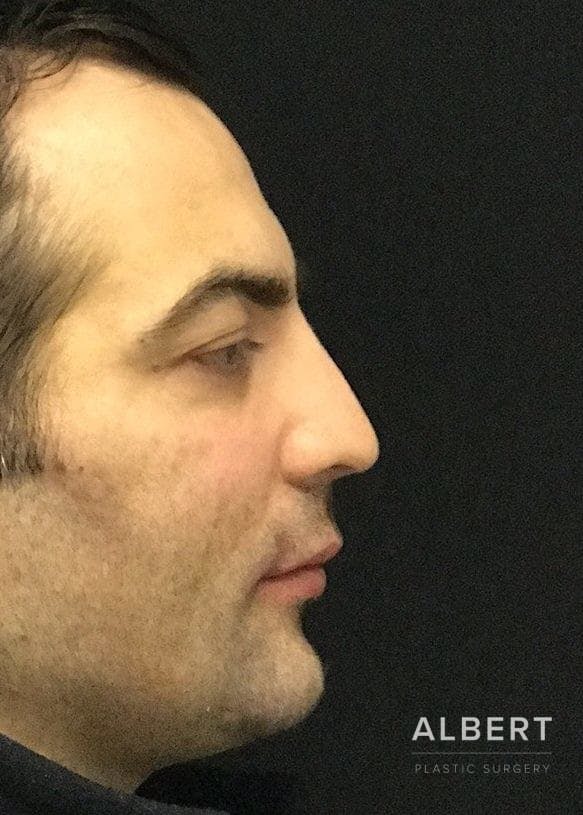 Facial Implants Before & After Gallery - Patient 151452121 - Image 5