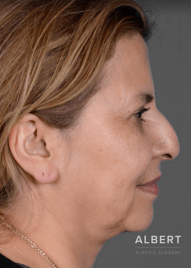 Rhinoplasty Before & After Gallery - Patient 151510784 - Image 1