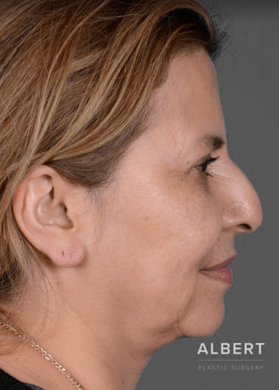 Rhinoplasty Before & After Gallery - Patient 151510784 - Image 1