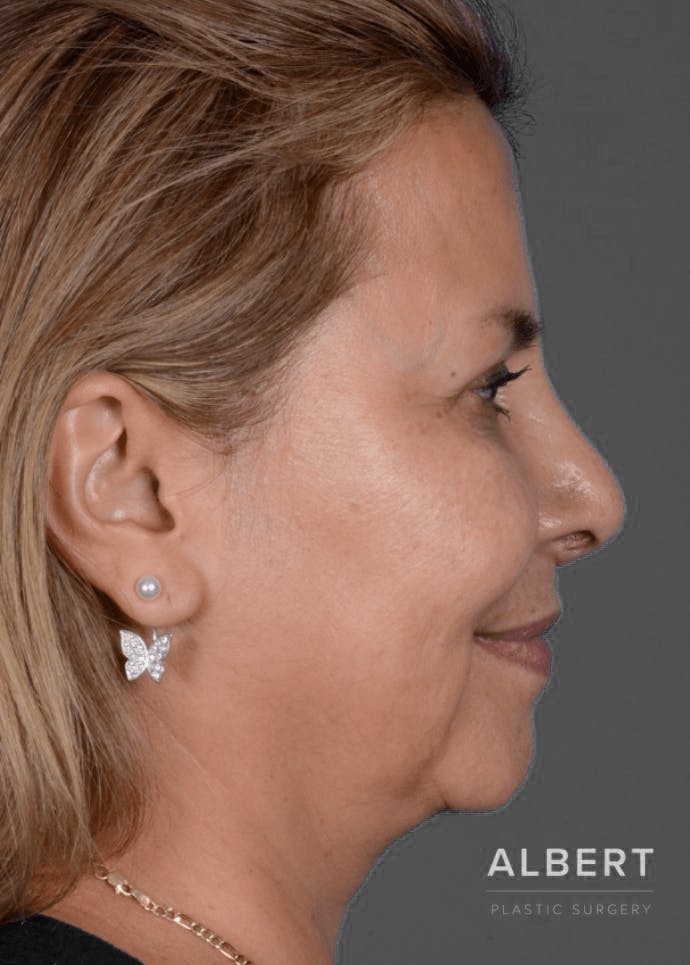 Rhinoplasty Before & After Gallery - Patient 151510784 - Image 2