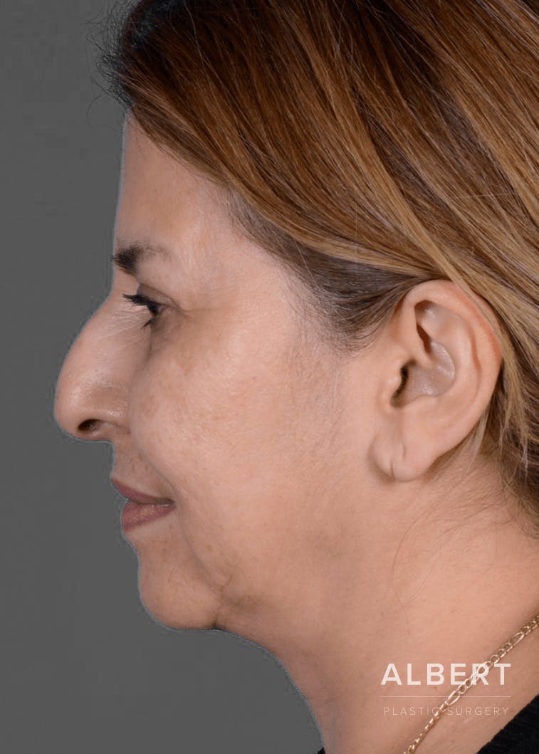 Rhinoplasty Before & After Gallery - Patient 151510784 - Image 9