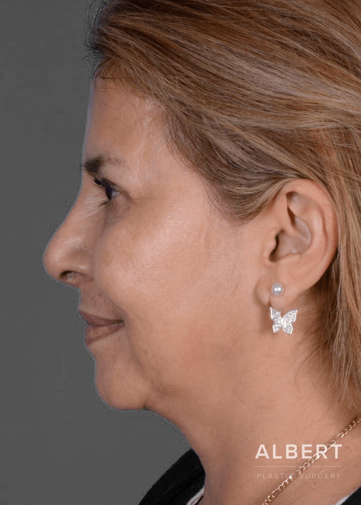 Rhinoplasty Before & After Gallery - Patient 151510784 - Image 10