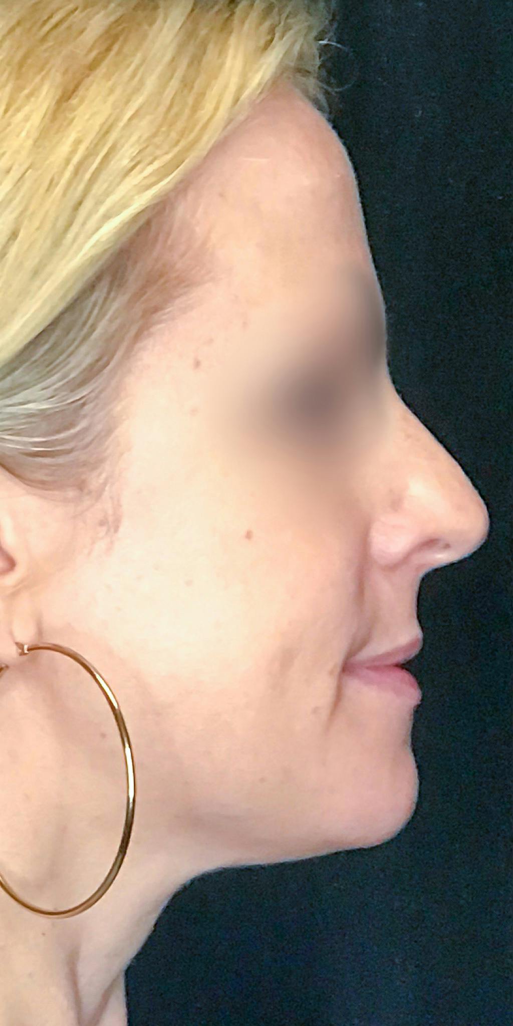 Rhinoplasty Before & After Gallery - Patient 151510783 - Image 1