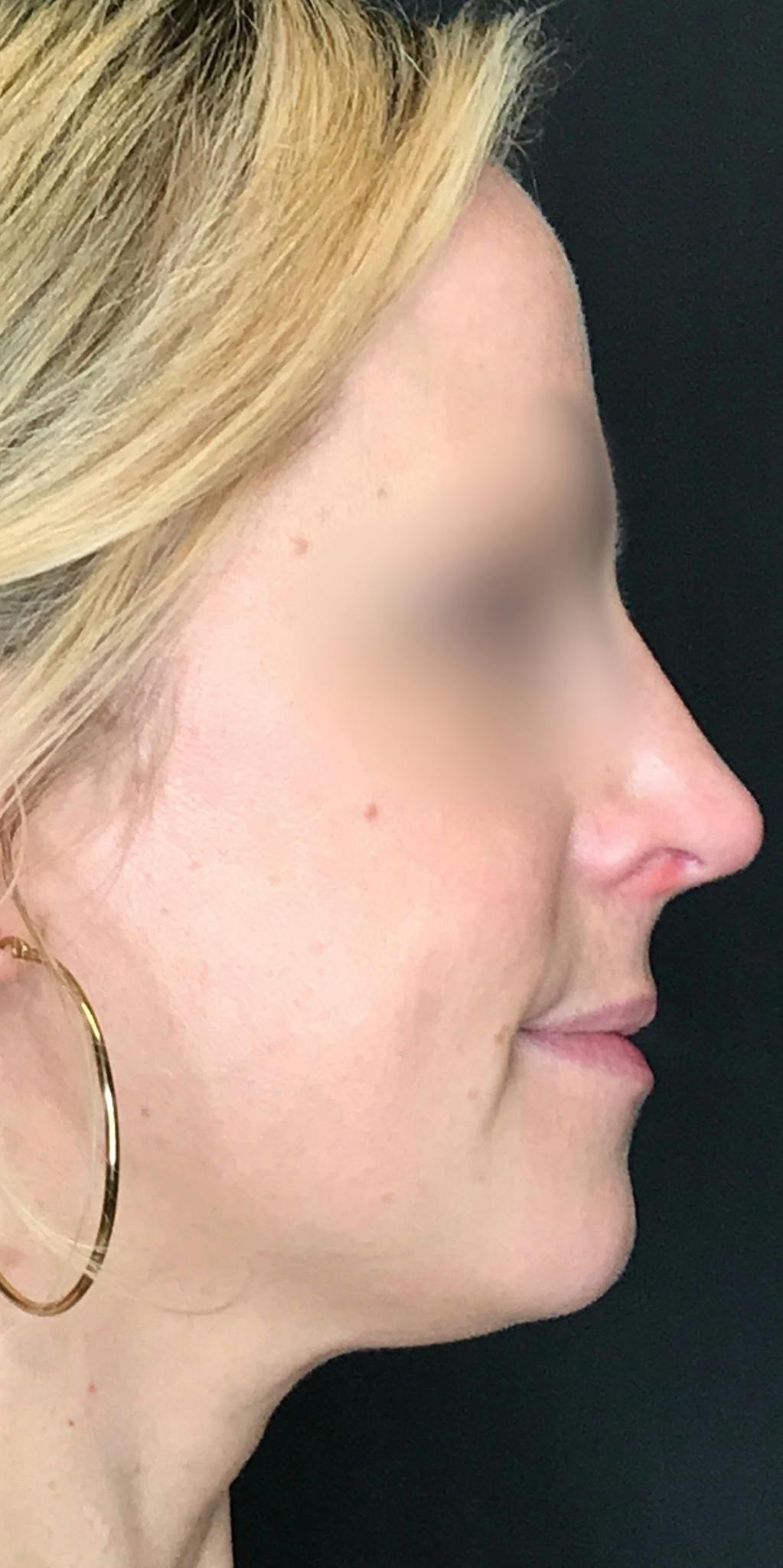 Rhinoplasty Before & After Gallery - Patient 151510783 - Image 2