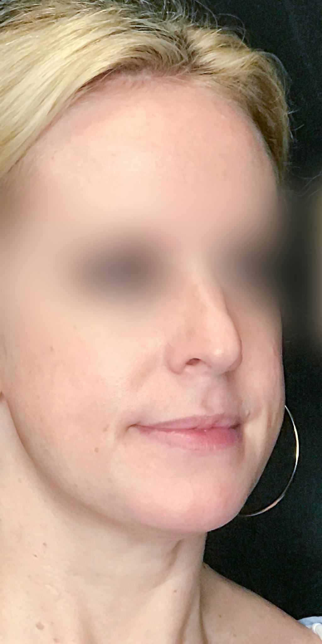 Rhinoplasty Before & After Gallery - Patient 151510783 - Image 3