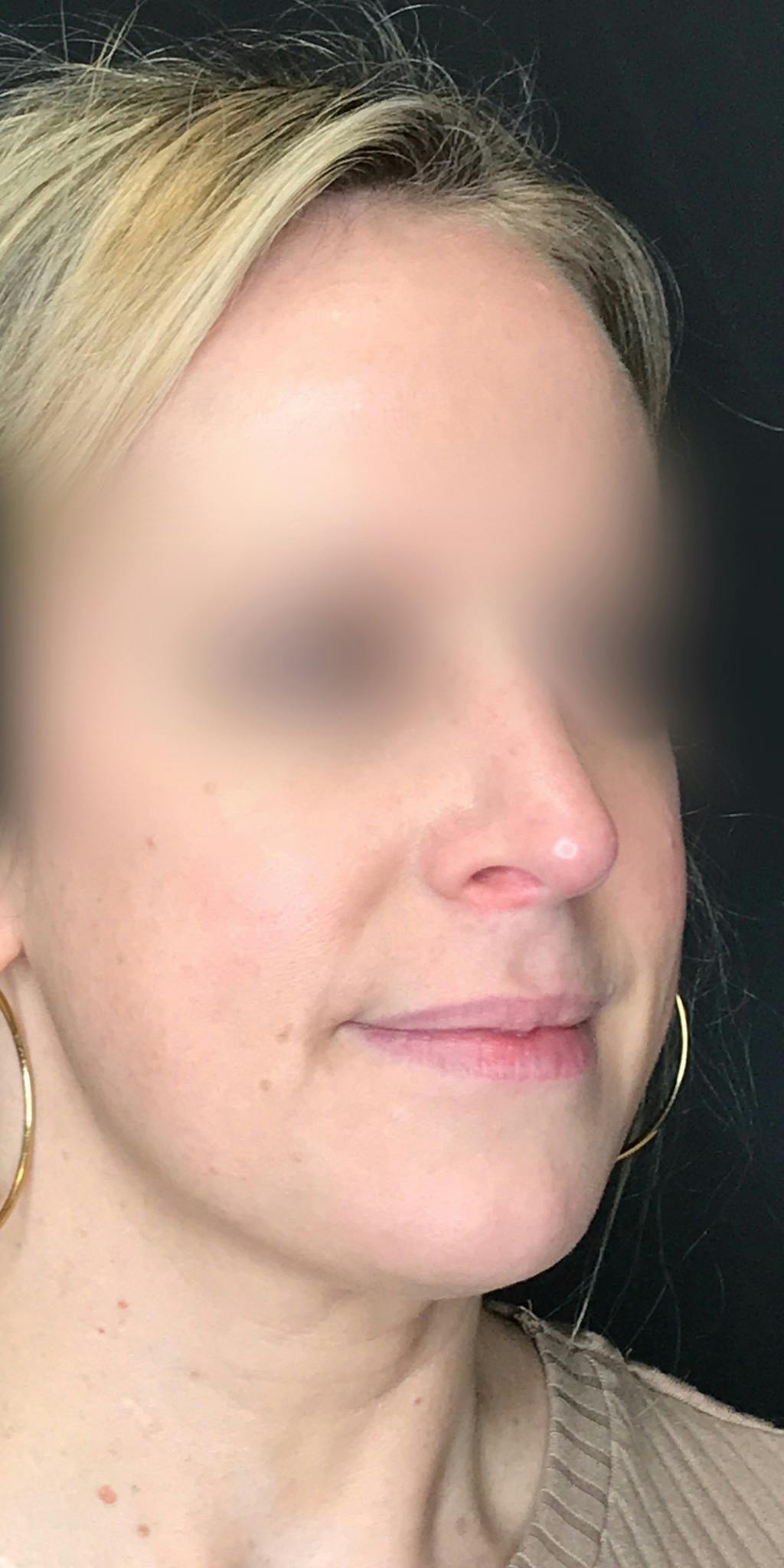 Rhinoplasty Before & After Gallery - Patient 151510783 - Image 4