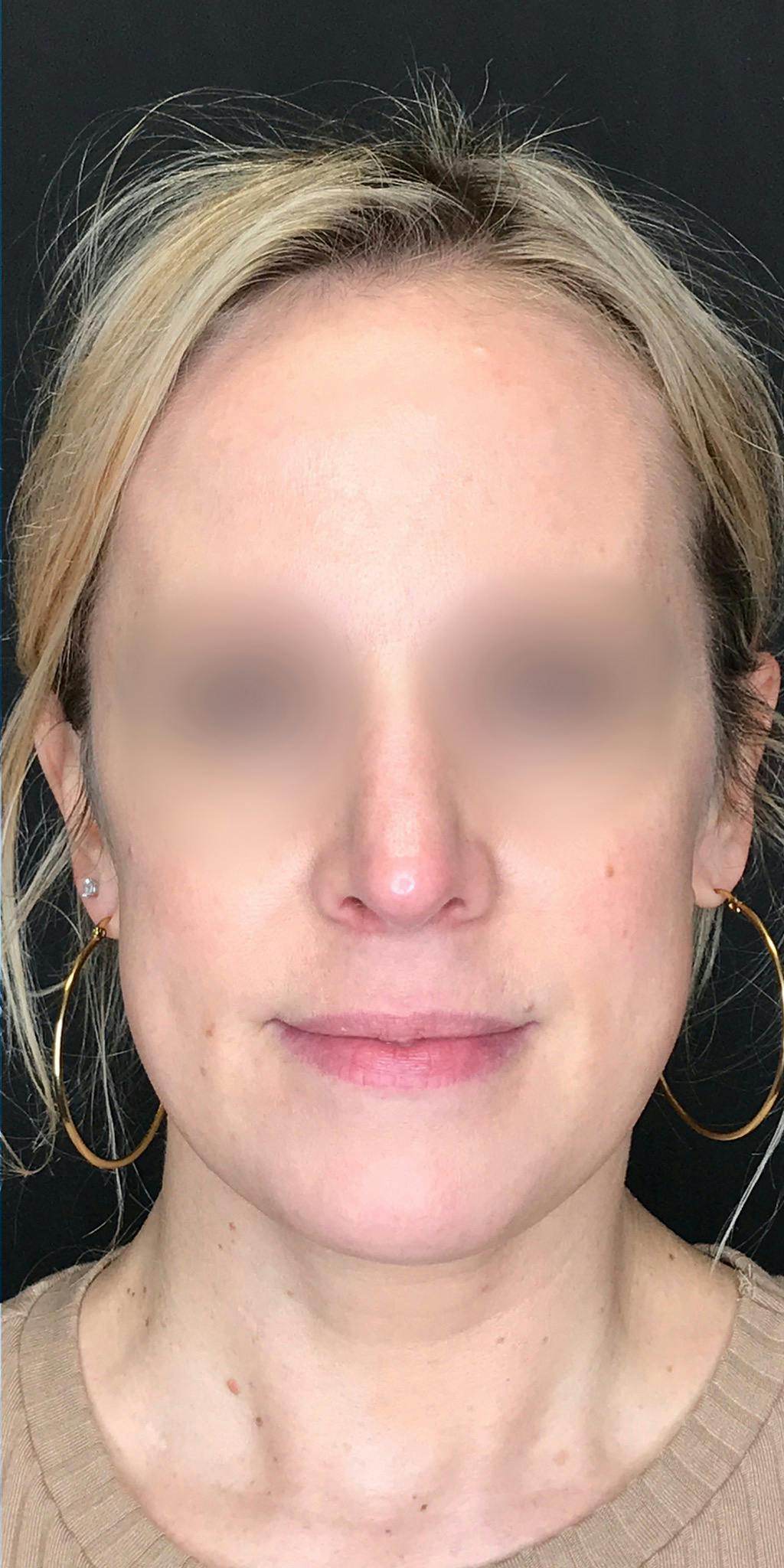 Rhinoplasty Before & After Gallery - Patient 151510783 - Image 6