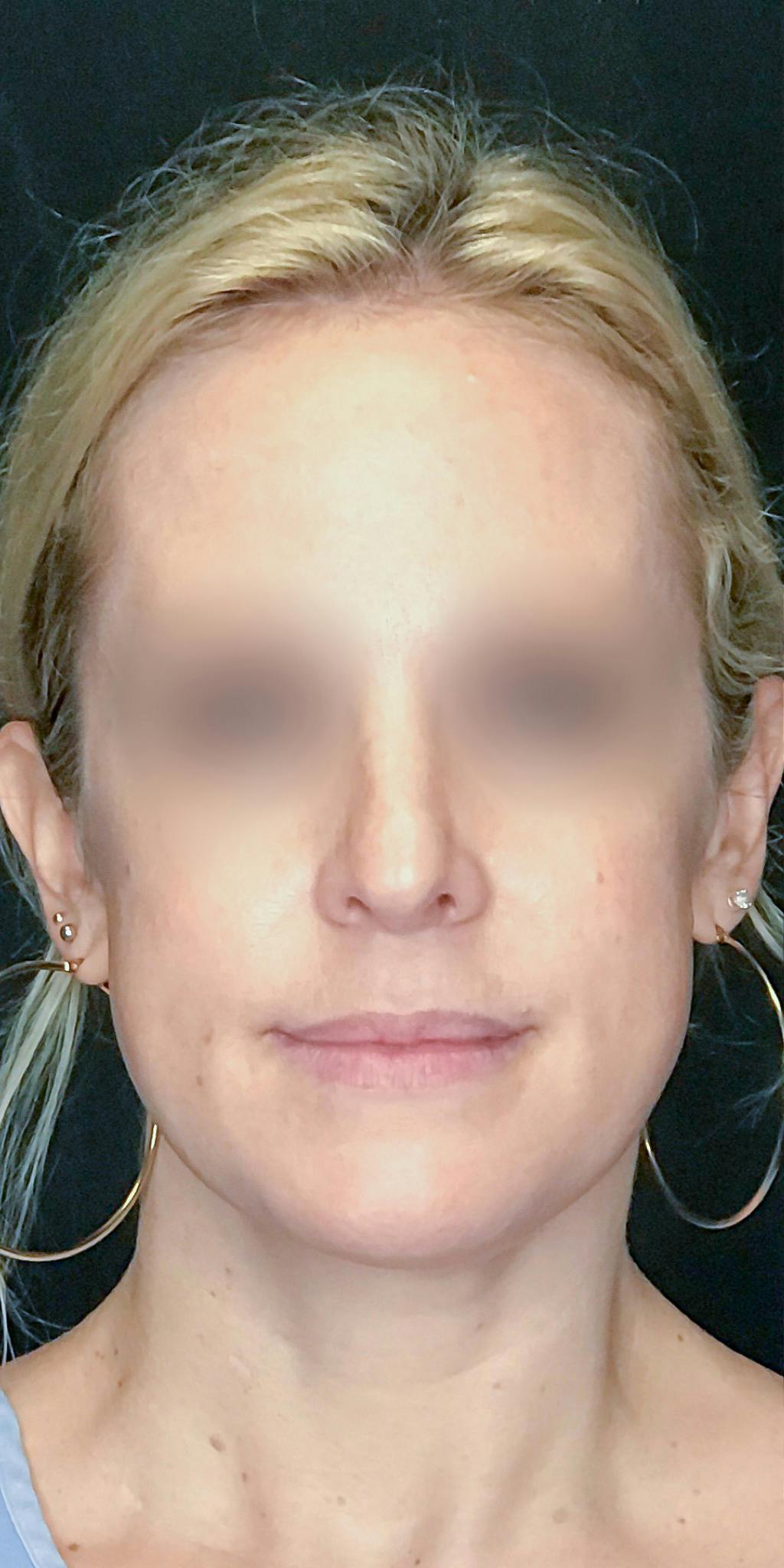 Rhinoplasty Before & After Gallery - Patient 151510783 - Image 5