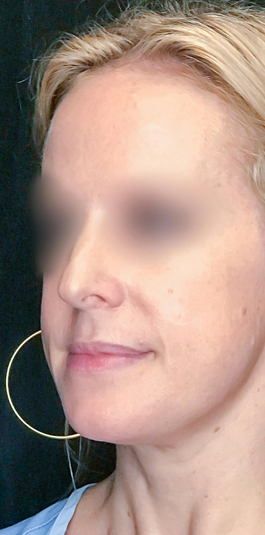 Rhinoplasty Before & After Gallery - Patient 151510783 - Image 7