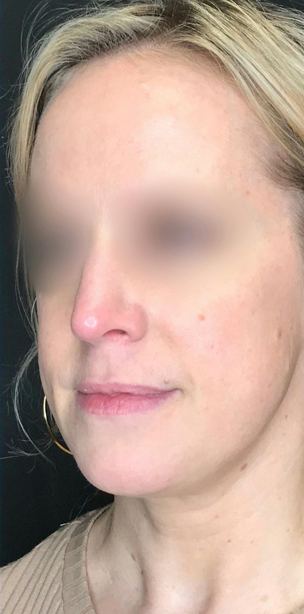 Rhinoplasty Before & After Gallery - Patient 151510783 - Image 8