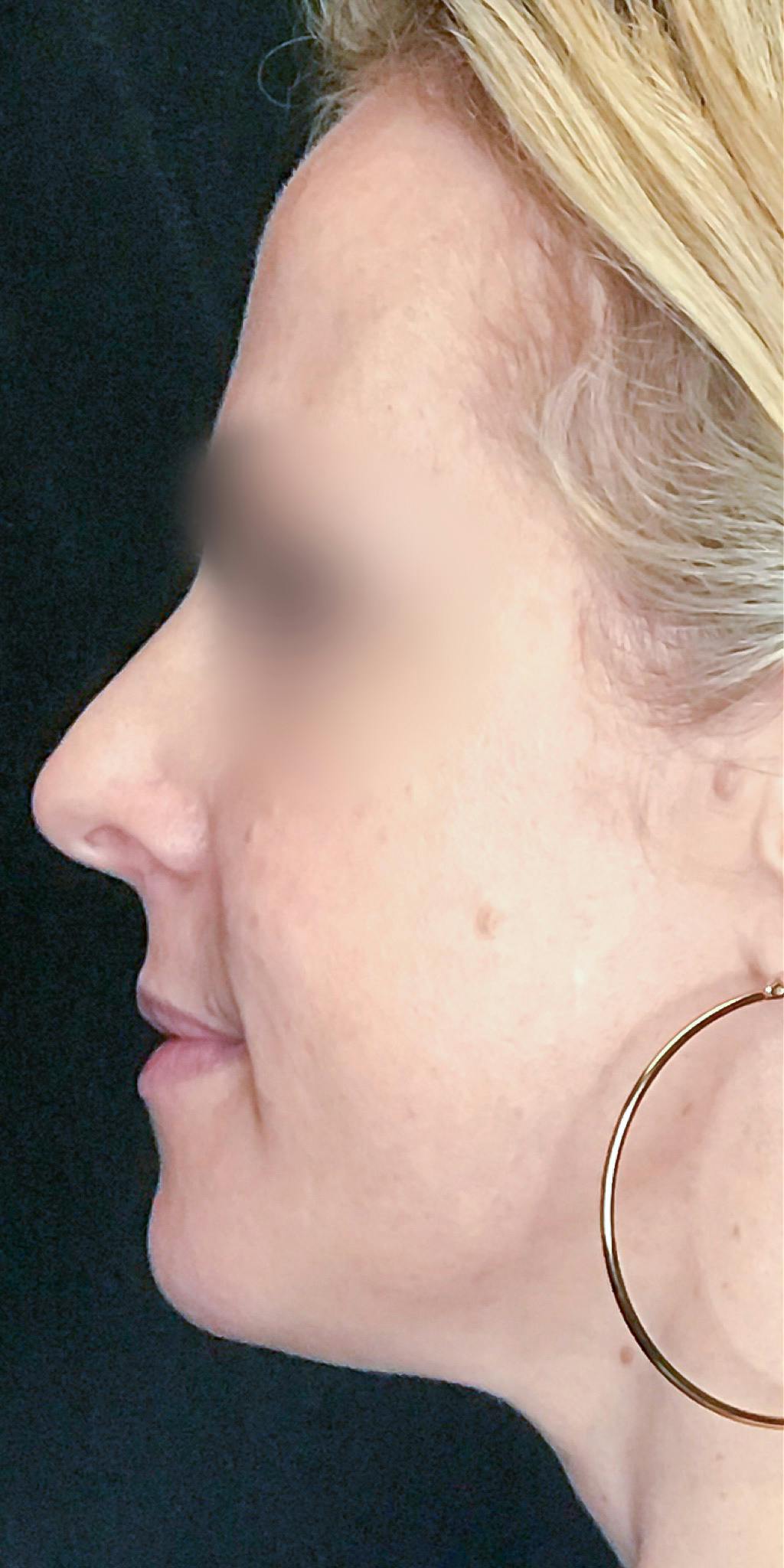 Rhinoplasty Before & After Gallery - Patient 151510783 - Image 9