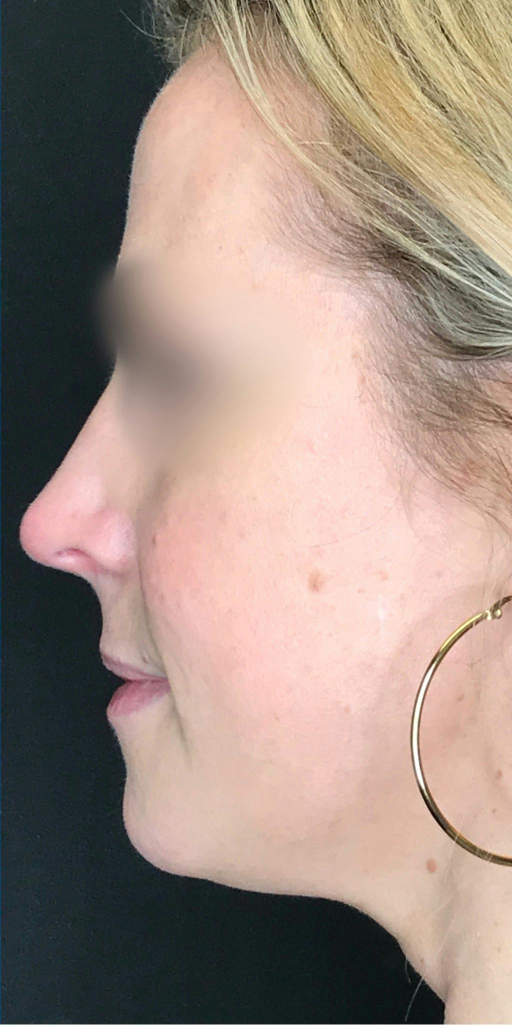 Rhinoplasty Before & After Gallery - Patient 151510783 - Image 10