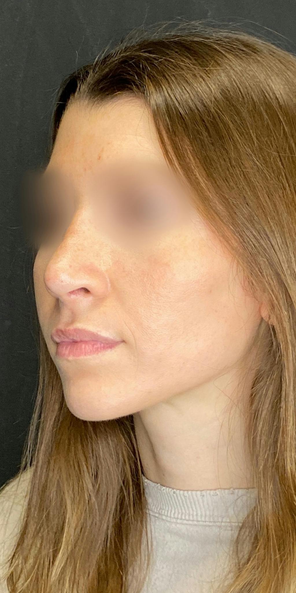 Rhinoplasty Before & After Gallery - Patient 151521037 - Image 8