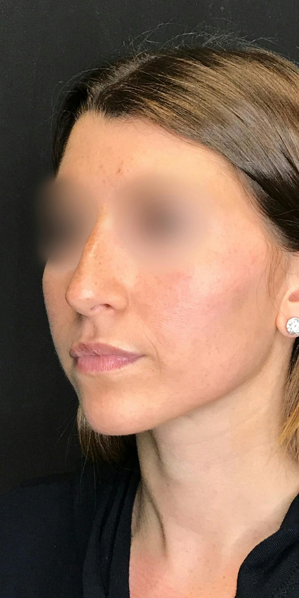 Rhinoplasty Before & After Gallery - Patient 151521037 - Image 7