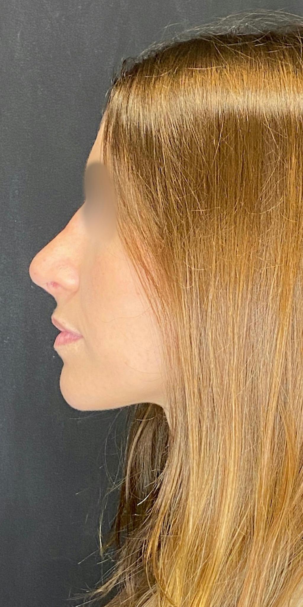 Rhinoplasty Before & After Gallery - Patient 151521037 - Image 10