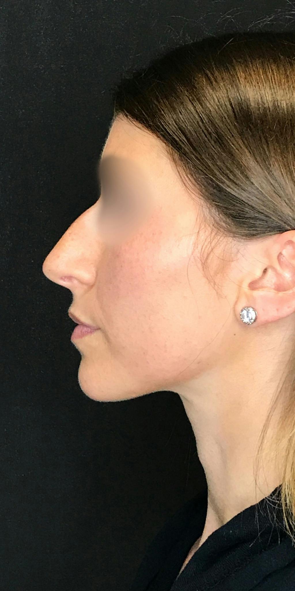 Rhinoplasty Before & After Gallery - Patient 151521037 - Image 9