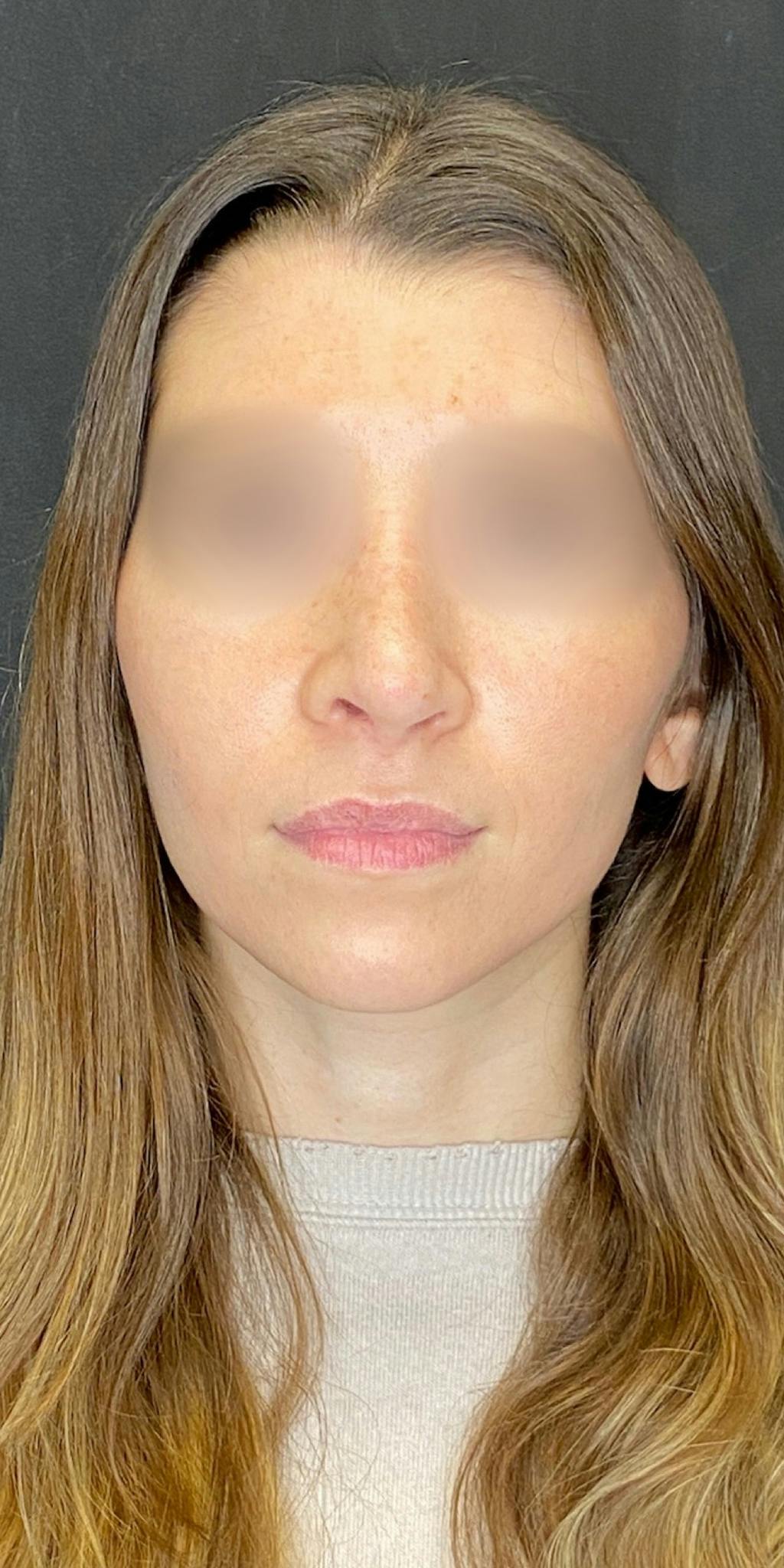 Rhinoplasty Before & After Gallery - Patient 151521037 - Image 6